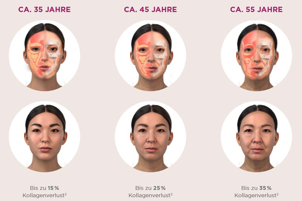 Sculptra Behandlung